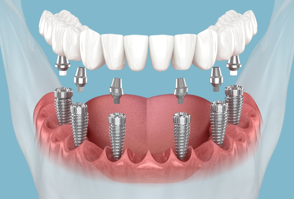  All Teeth Implants treatment