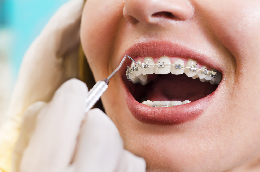 Braces Treatment Braces Treatment