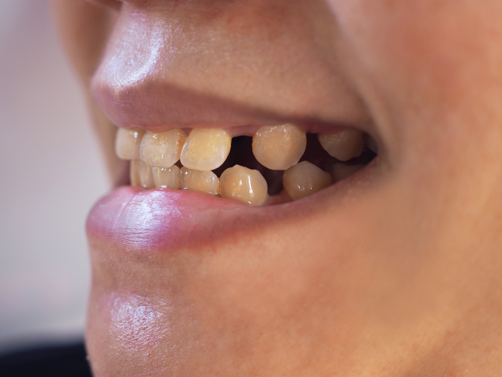 Gap Closer Treatment Gap Closer Treatment