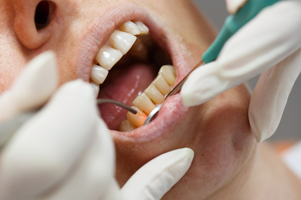 Gum Surgery Gum Surgery